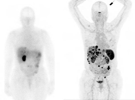 Comparison scans of the same neuroendocrine cancer patient; one using gallium-68 DOTATATE (right) and one without (left). Gallium-68 DOTATATE is a radioactive tracer that displays neuroendocrine tumours with utmost accuracy, so even the smallest traces of cancer light up on the screen.